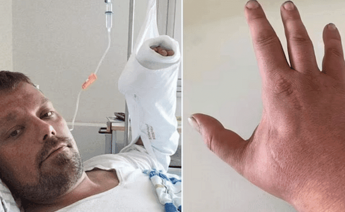 Hombre que fue mordido por un gato murió por una bacteria “come-carne”