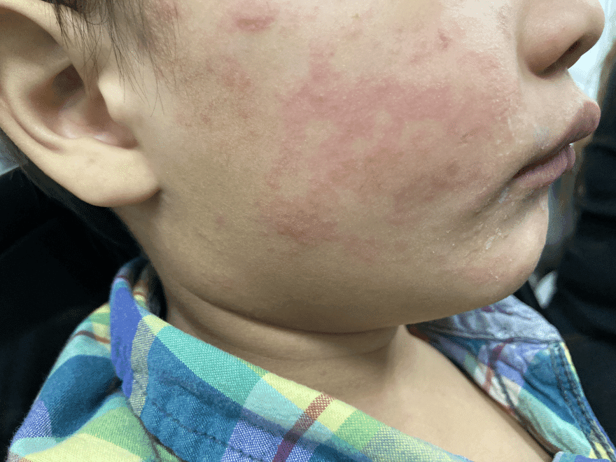 Brote de sarampión en Texas causa la muerte de un niño no vacunado