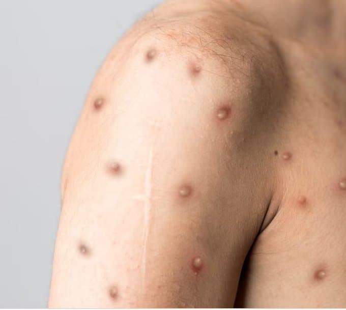 Perú se acerca a los cien casos de la viruela del mono