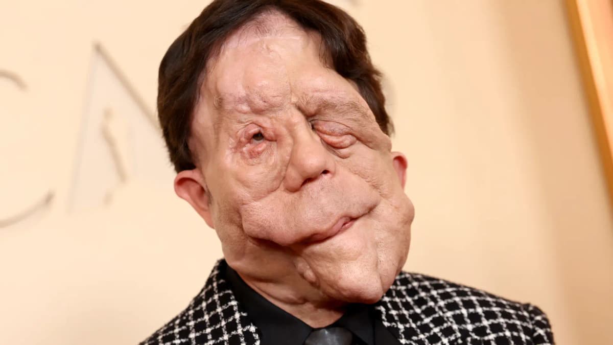 Así es la rara enfermedad que afecta el rostro de Adam Pearson