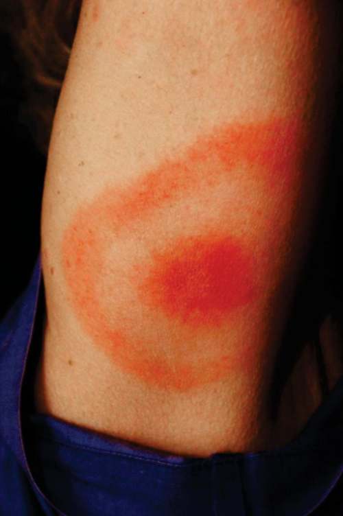 La enfermedad de Lyme cómo puedo prevenirla
