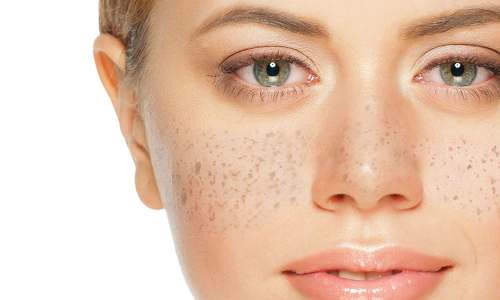 Por qué aparecen las pecas en la piel
