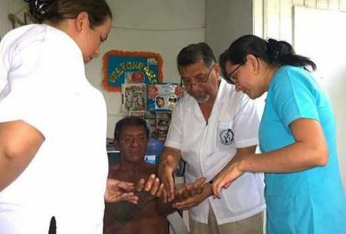 Primer contagio de lepra en Piura impulsa alerta sanitaria