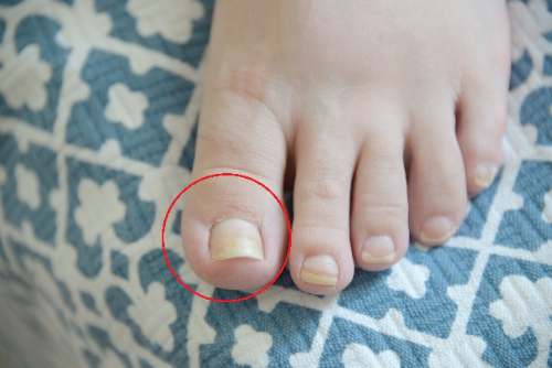 Hongos en las uñas de los pies
