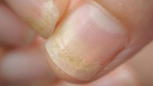 Enfermedades que se detectan a través de las uñas