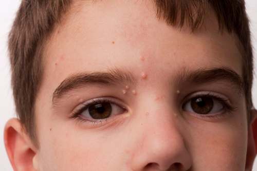 Moluscos en la piel de los niños