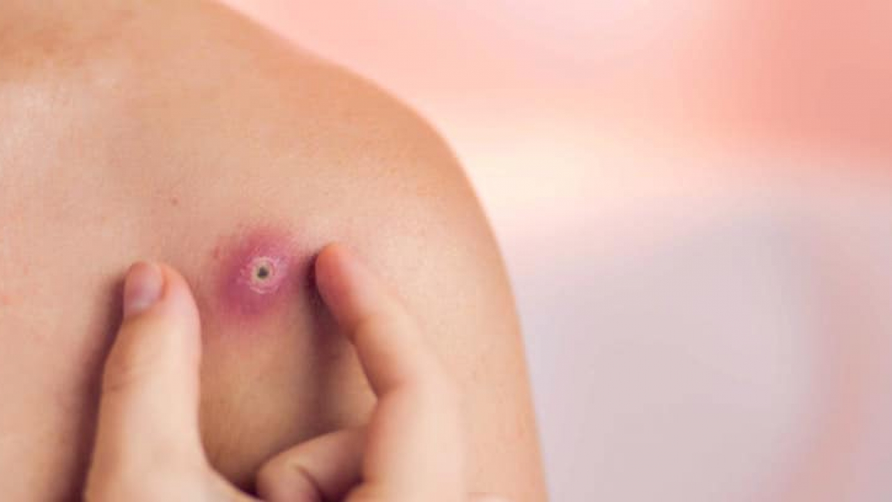 La Foliculitis: es de cuidados