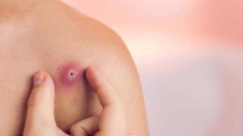 La Foliculitis: es de cuidados