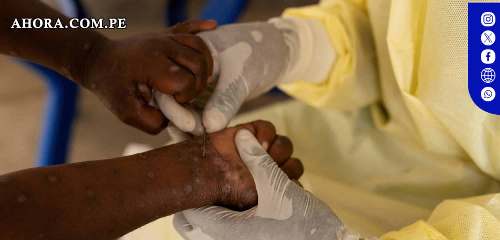 OMS declara alerta global por brote de Mpox en África