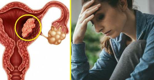 Los pólipos uterinos qué son?