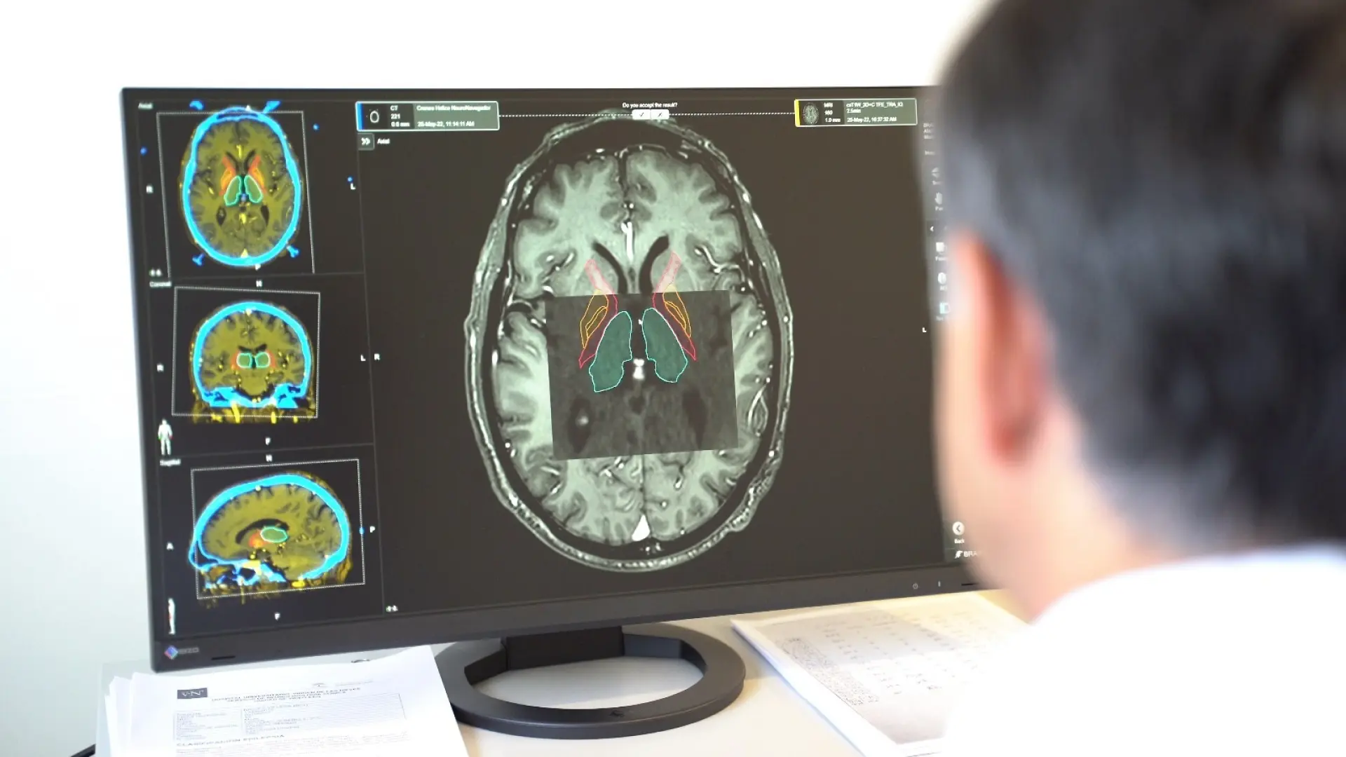 Parkinson se duplicó en 25 años: Estudio revela las razones