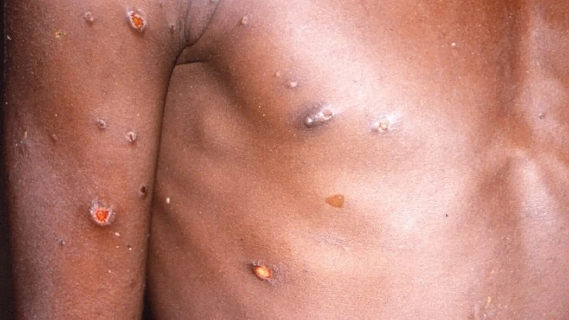 OMS: Viruela del mono amenaza contagio masivo si no se frena