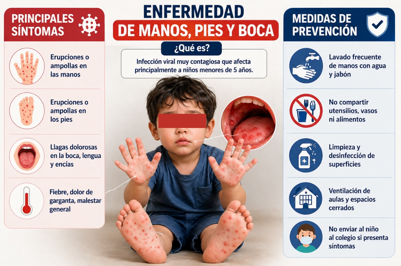 Trece colegios de Huánuco suspenden clases por brote de enfermedad de manos, pies y boca