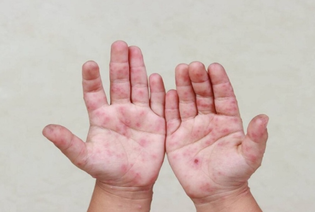 Lambayeque activa cerco epidemiológico por virus de manos, pies y boca