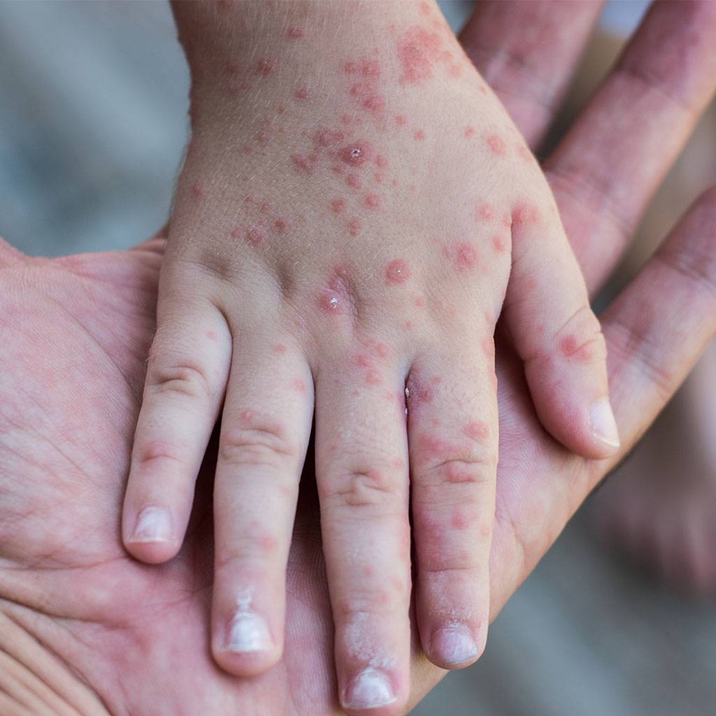 Red de Salud reporta disminución de cuadros de mano-pie-boca tras las vacaciones escolares
