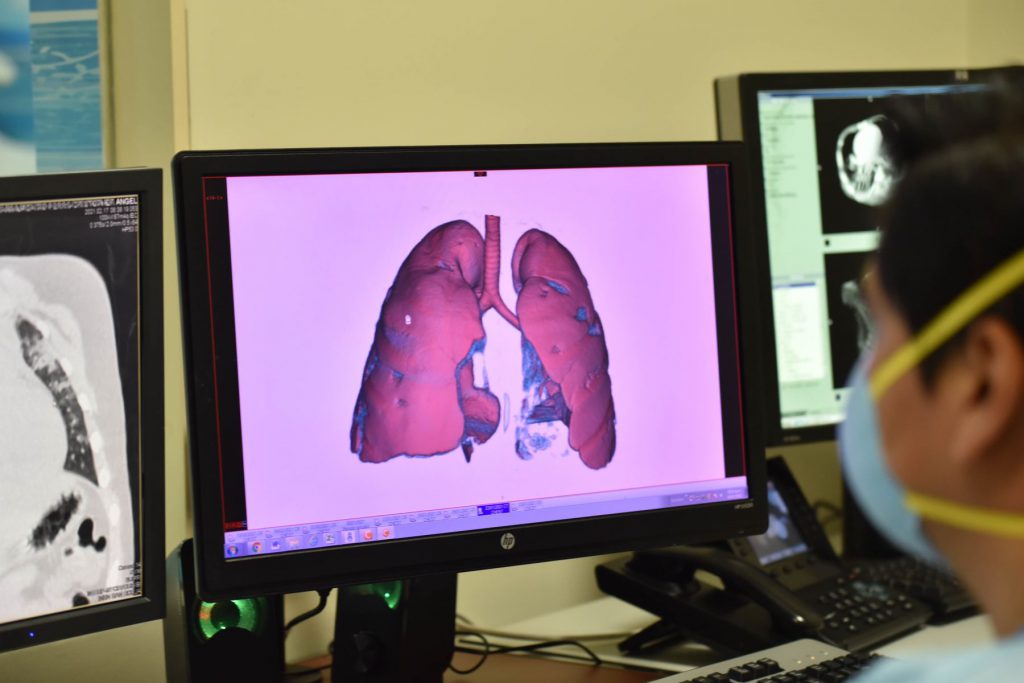 Adolescentes con coronavirus están llegando a UCI con gran daño pulmonar