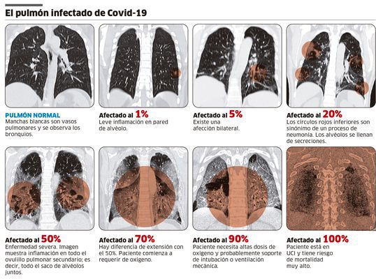 Casos de COVID-19 en segunda ola presentan daño severo en los pulmones en menos tiempo