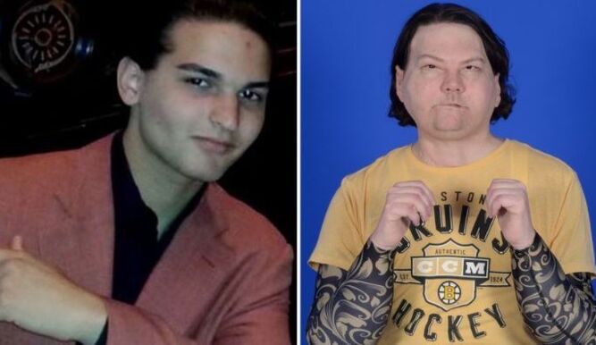 Joven de 22 años recibe primer trasplante de cara y manos en EE. UU.