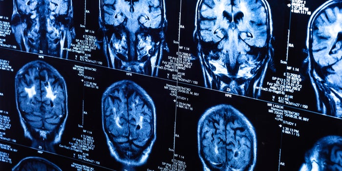 La COVID-19 reduce el volumen de materia gris en el cerebro, según estudio