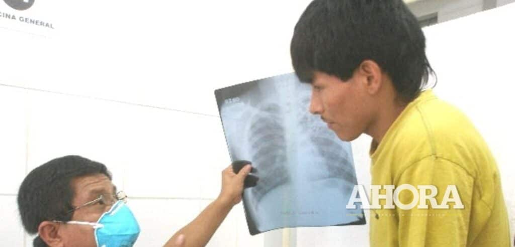 Huánuco y Leoncio Prado lideran casos de personas contagiadas con tuberculosis