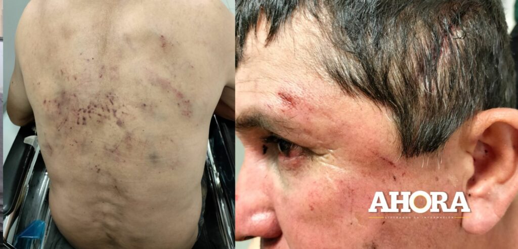 Obrero detenido por agresión habría sido atacado con machete por su conviviente