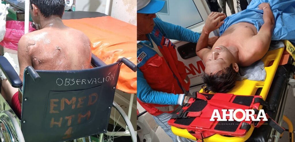 Fuga de gas en grifo de Tingo: Joven termina con quemaduras en el 18 % de su cuerpo