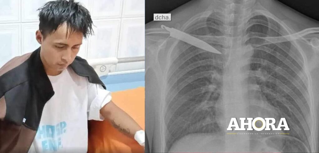 Víctima de asalto vivió un mes con un cuchillo clavado en la espalda sin saberlo