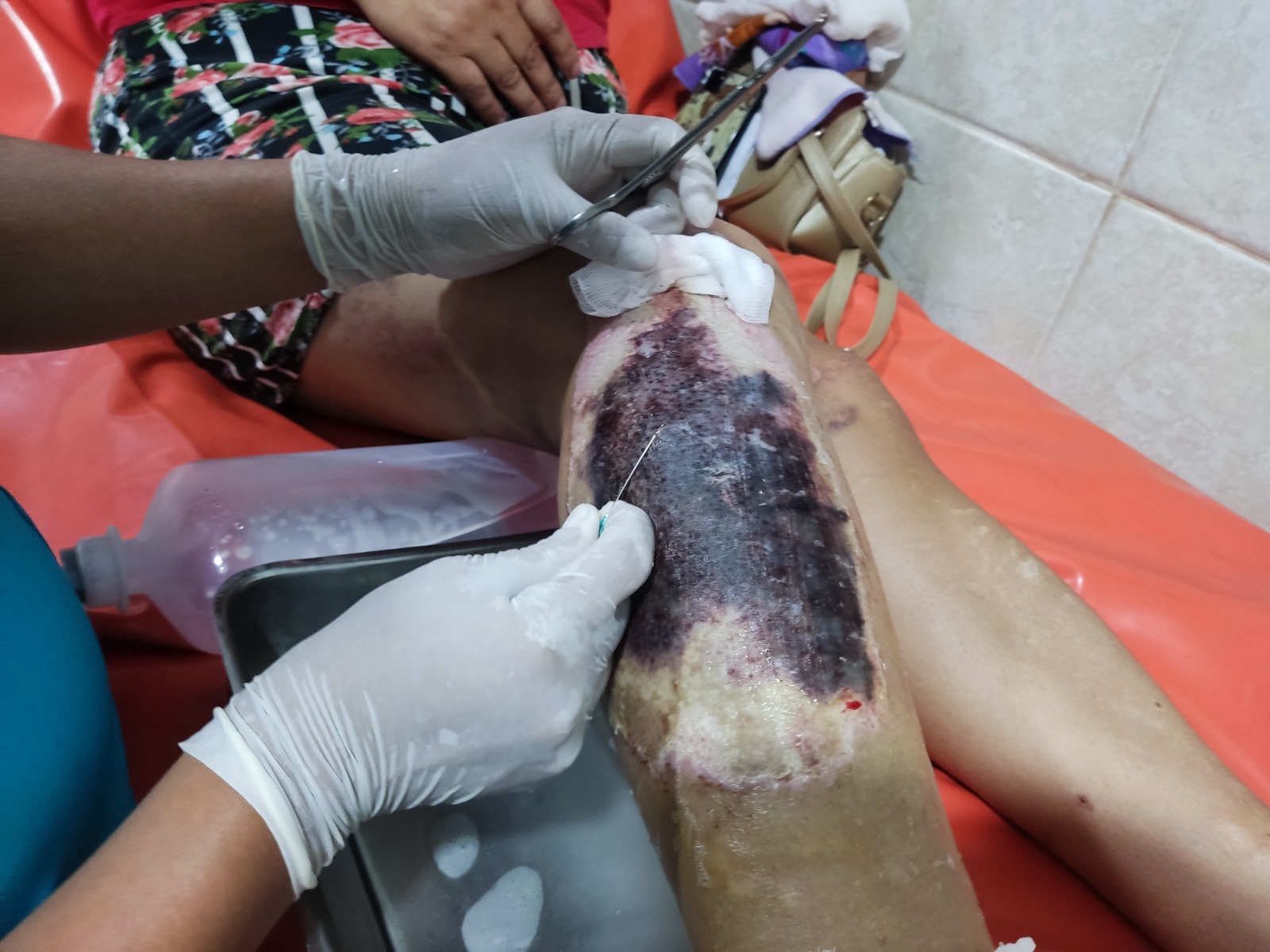 Personal De Salud En Castillo Grande Evita Amputacion Con Atencion Oportuna